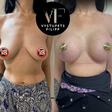 Подтяжка груди в Москве с имплантацией врач Ф.В. Выступец